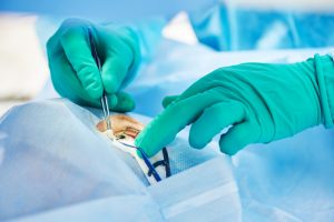 Augenoperation als möglicher Auslöser trockener Augen