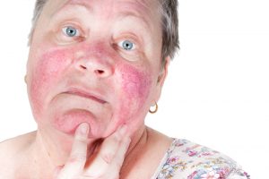 Rosazea als möglicher Zusammenhang mit trockenen Augen